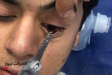 النجف.. عملية جراحية طارئة لإخراج جسم غريب من عين شاب